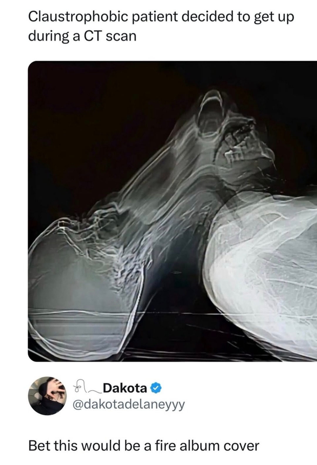 Claustrophobic patient decided to get up during a CT scan
Bet this would be a fire album cover