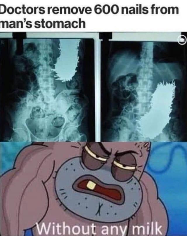 Doctors remove 600 nails from man's stomach Without any milk