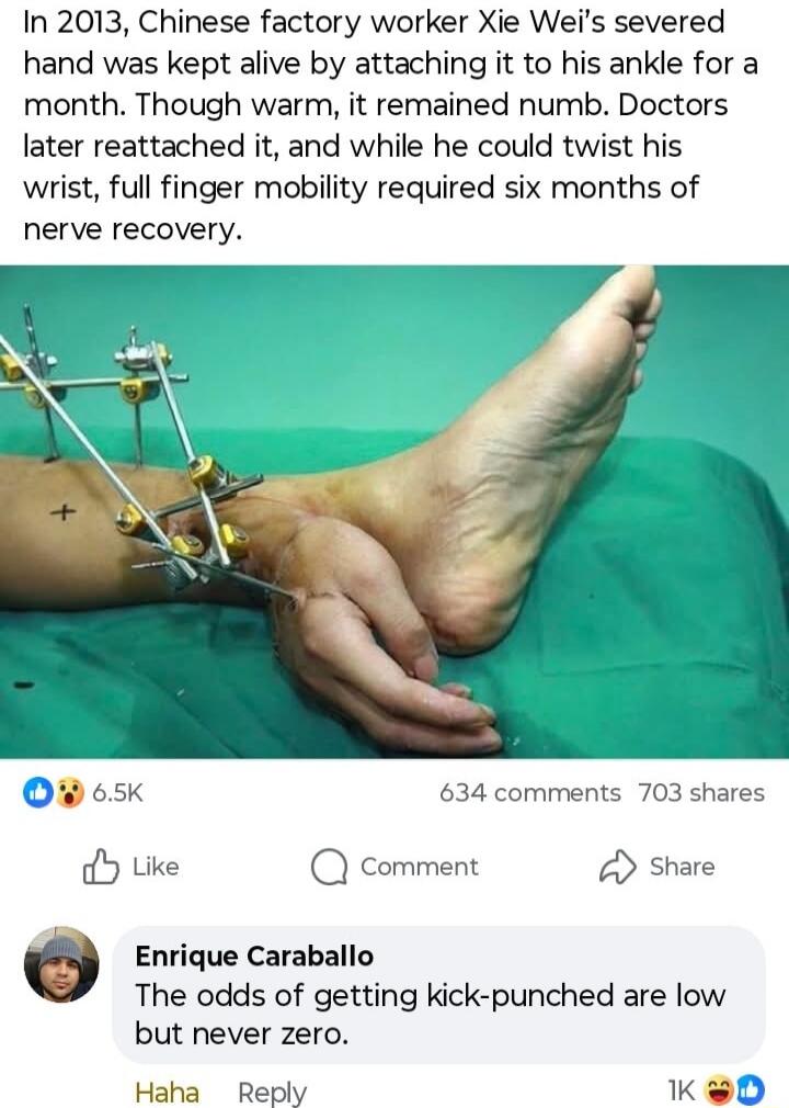 In 2013, Chinese factory worker Xie Wei's severed hand was kept alive by attaching it to his ankle for a month. Though warm, it remained numb. Doctors later reattached it, and while he could twist his wrist, full finger mobility required six months of nerve recovery.