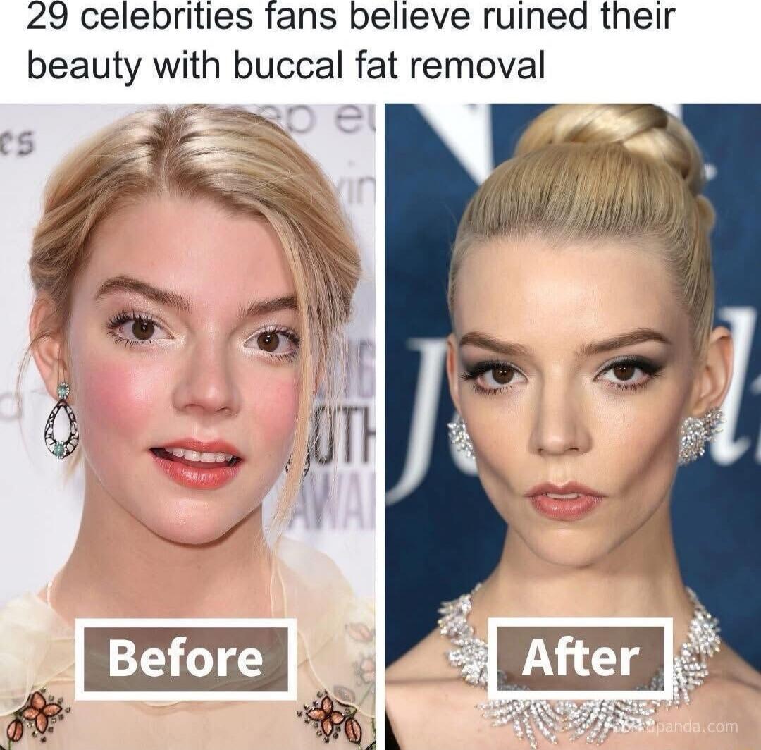 29 celebrities fans believe ruined their beauty with buccal fat removal Before After
