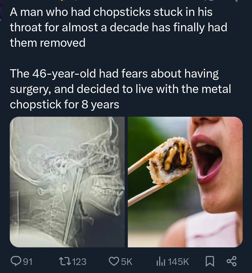 A man who had chopsticks stuck in his throat for almost a decade has finally had them removed. The 46-year-old had fears about having surgery, and decided to live with the metal chopstick for 8 years.