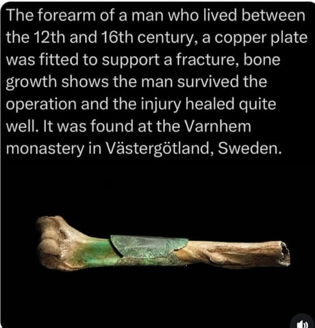 The forearm of a man who lived between the 12th and 16th century, a copper plate was fitted to support a fracture, bone growth shows the man survived the operation and the injury healed quite well. It was found at the Varnhem monastery in Västergötland, Sweden.