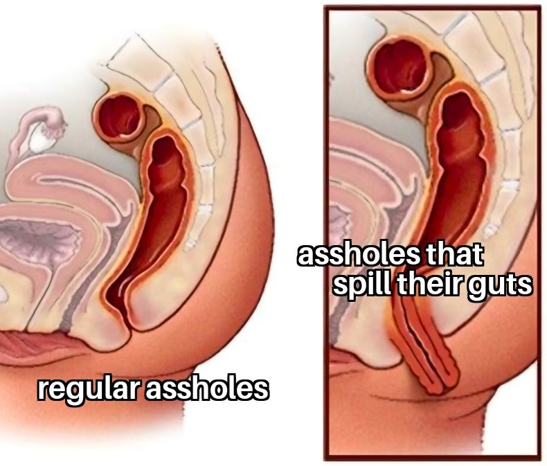 regular assholes, assholes that spill their guts