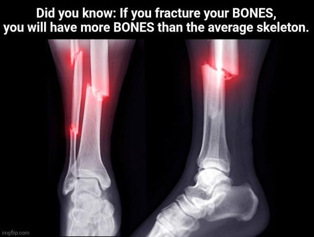Did you know: If you fracture your BONES, you will have more BONES than the average skeleton.