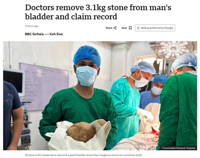 Doctors remove 3.1kg stone from man's bladder and claim record. 3 hours ago. BBC Sinhala and Koh Ewe. Doctors in Sri Lanka have removed a giant bladder stone that weighs as much as a newborn child. Trincomalee General Hospital.